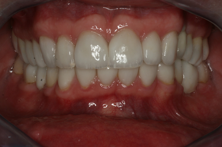 Zahnsanierung Vollnarkose Erfahrungen